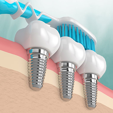 Regular Horizontal Image 483x483-implants